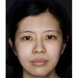 After Treatment